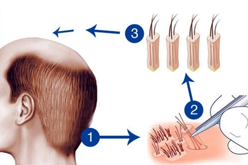 cấy tóc tự thân